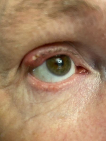 Eye advice