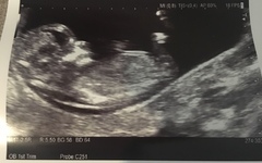 Gender guesses from 12 week scan