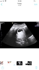 Blighted Ovum scan help