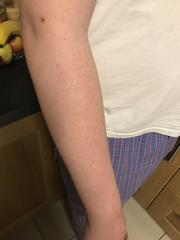 Rash