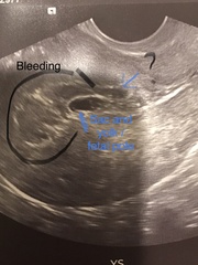 Support thread for women who are pregnant or TTC following a termination for abnormalities. Thread 7