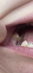 What does dry socket look like does anyone know?