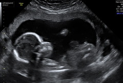 Anyone worried their private gender scan is wrong?