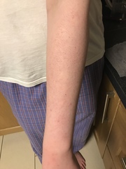 Rash