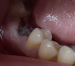 What does dry socket look like does anyone know?