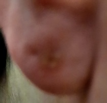 Infected piercing *warning photos*