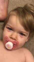Rash around 16 month old eyes - allergic? Form of dermatitis?