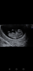 What could you see at 8 week scan?