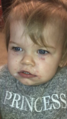 Rash around 16 month old eyes - allergic? Form of dermatitis?
