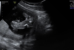 Anyone worried their private gender scan is wrong?