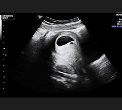 Blighted Ovum scan help