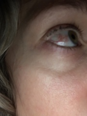 Eye has been bloodshot since august!