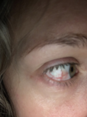 Eye has been bloodshot since august!