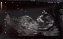 Any guesses as to the baby's sex? skull theory? nub theory?