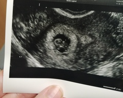 What could you see at 8 week scan?