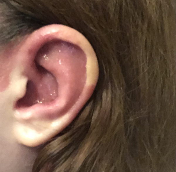 Bloody hell my ear!!! <pic included>