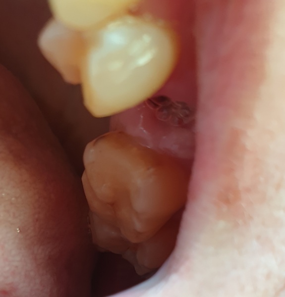 Dry socket?