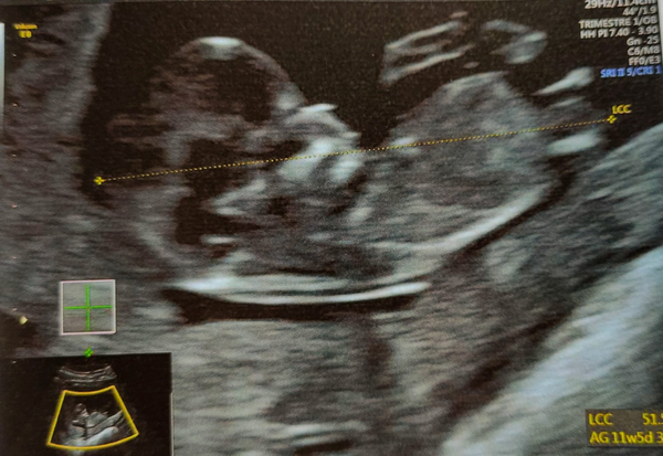 Pregnant After MMC - Thread 5