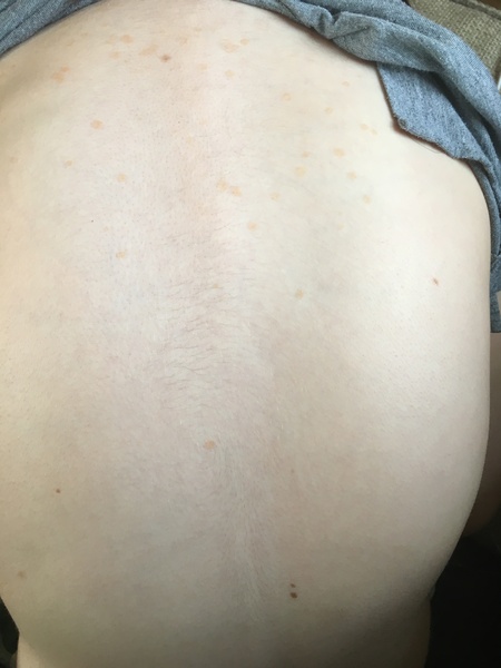 What is this rash?
