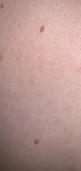 Does this mole / skin tag look abnormal ?