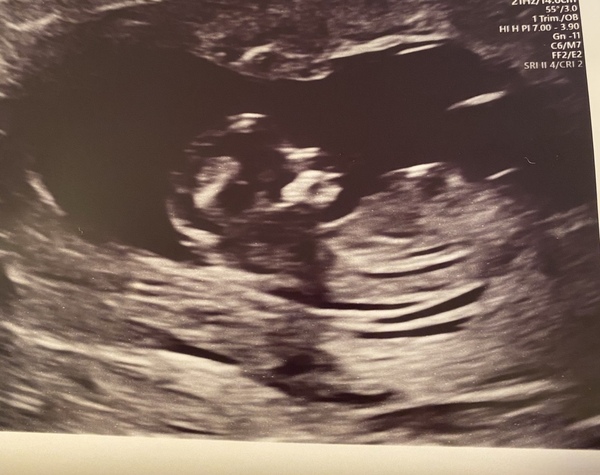 Do you want me to guess the sex? 12 week scans.