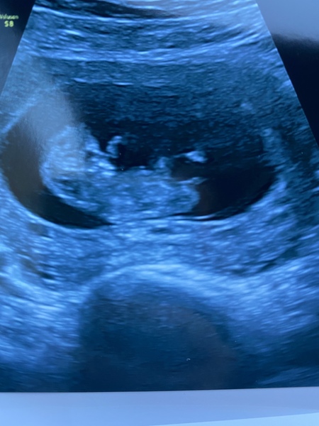 Do you want me to guess the sex? 12 week scans.