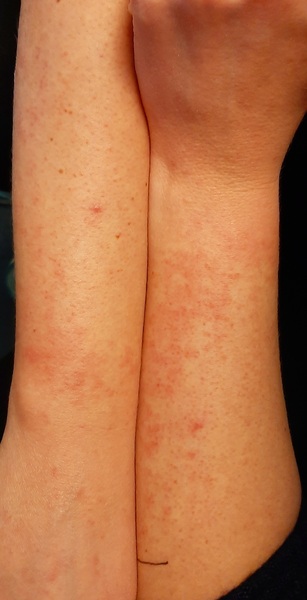 Did anyone else's covid start as a rash?