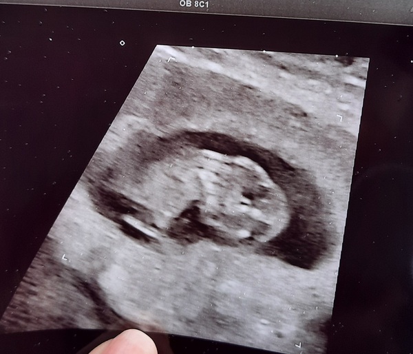 Starting TTC again after missed miscarriage part two