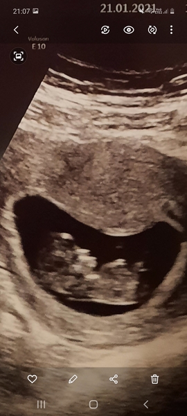 Starting TTC again after missed miscarriage part two