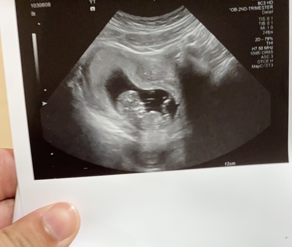 Do you want me to guess the sex? 12 week scans.