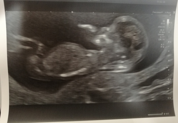 Do you want me to guess the sex? 12 week scans.
