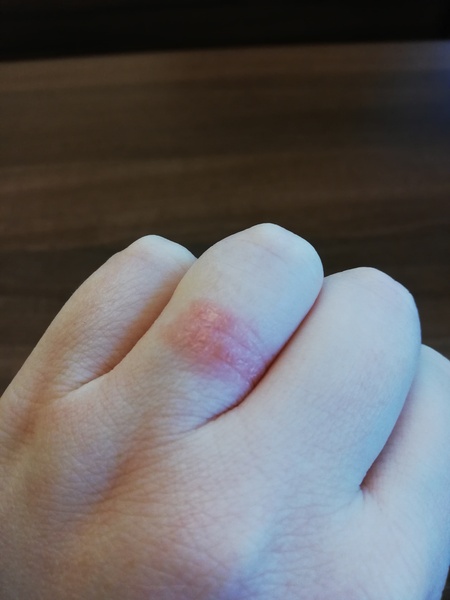 Recurrent miscarriage testing - 1st app