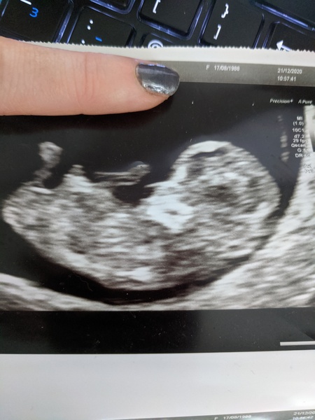 Do you want me to guess the sex? 12 week scans.