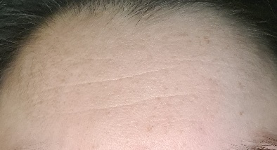 Would you get botox?