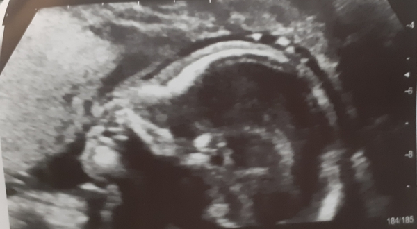 Do you want me to guess the sex? 12 week scans.