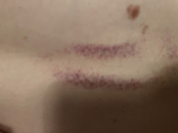 What is this rash/mark?