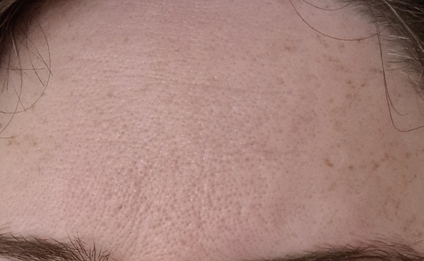What will help my forehead? *pic included*