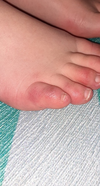 Covid Toe