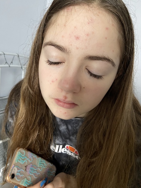 Roaccutane or Yasmin