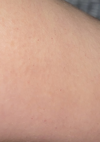 Red spots petachai? Pregnancy
