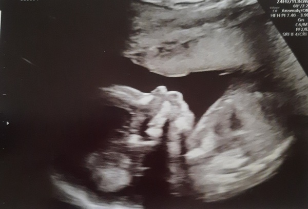Pregnant After MMC - Thread 4