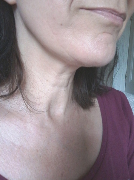 Jowls and jawline