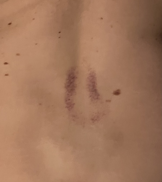 What is this rash/mark?