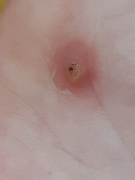 Is this a wart?