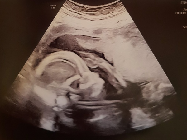 Pregnant After MMC - Thread 5
