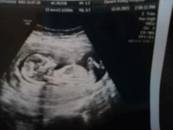 Do you want me to guess the sex? 12 week scans.