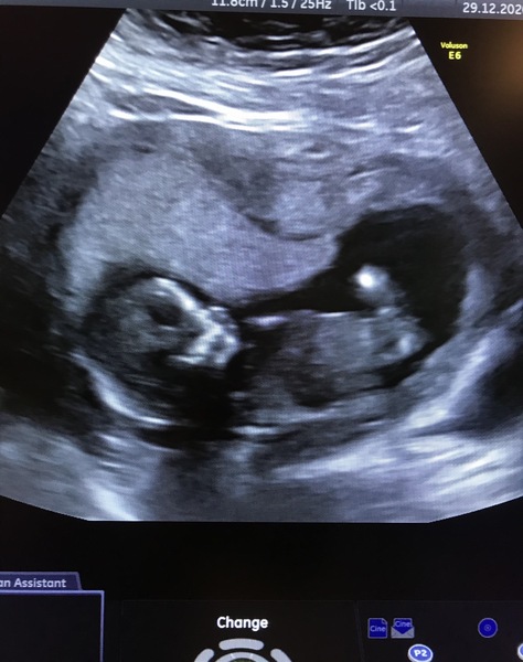 Do you want me to guess the sex? 12 week scans.