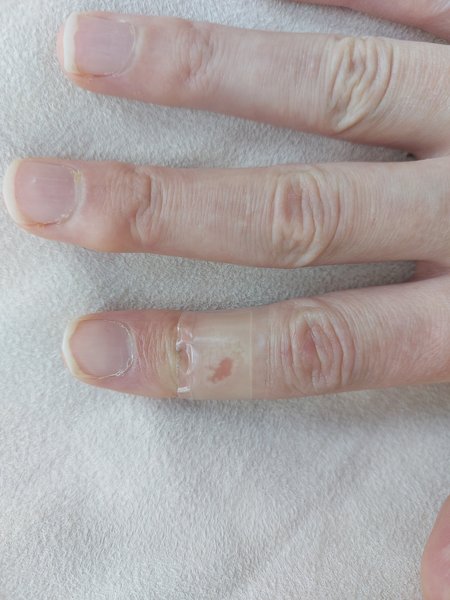 Help - too anxious over tiny burn