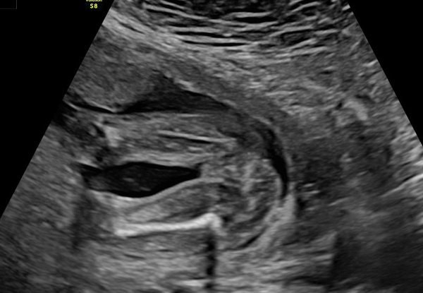 Gender scan experiences? Anyone ever been told wrong?