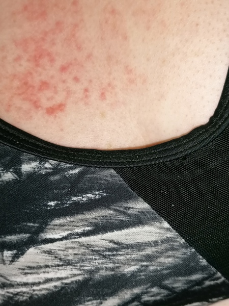 Did anyone else's covid start as a rash?